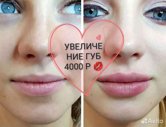 Увеличение губ, липолитики, ботулинотерапия
