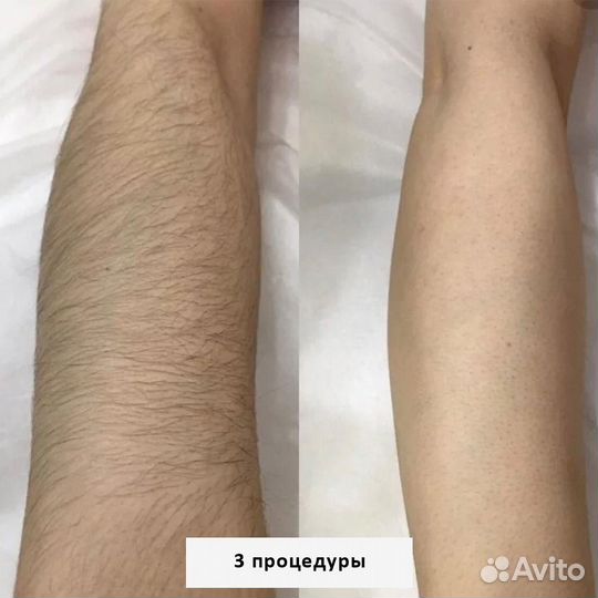 Лазерная эпиляция