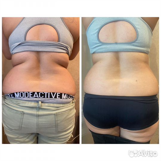 Похудение, коррекция фигуры, тейпирование тела