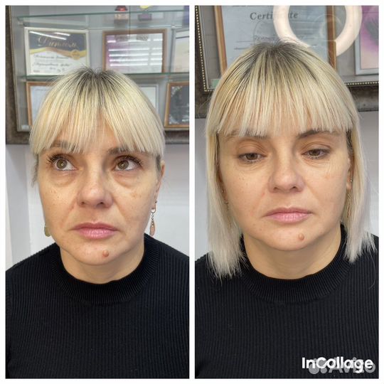 Буккальный массаж