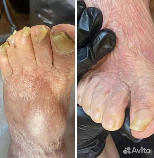 Подолог есть выезд, грибки вросшие ногти и др
