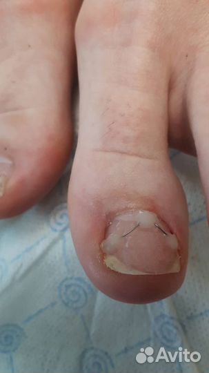 Медицинский педикюр, услуги подолога выезд на дом