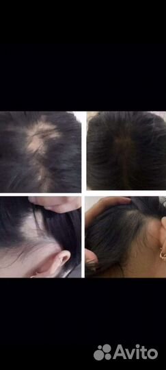 Спрей от выпадения волос. Atomy