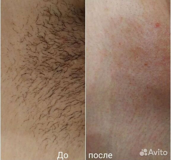 Депиляция воском: бёдра