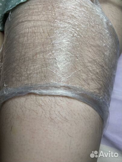 Электроэпиляция