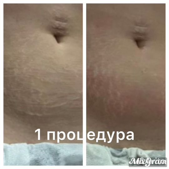 Аппарат Индиба (indiba) Похудение, омоложение