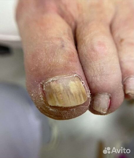 Медицинский педикюр подолог