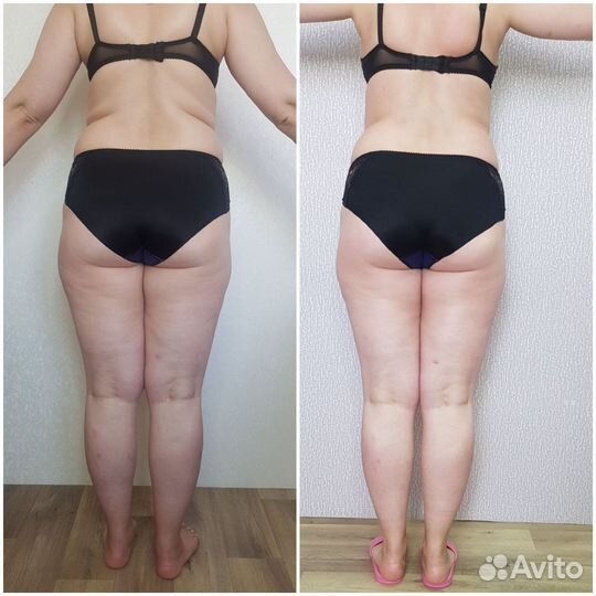 Прессотерапия