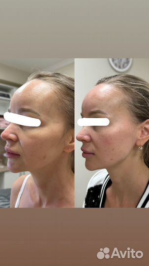 Омолаживающий массаж лица