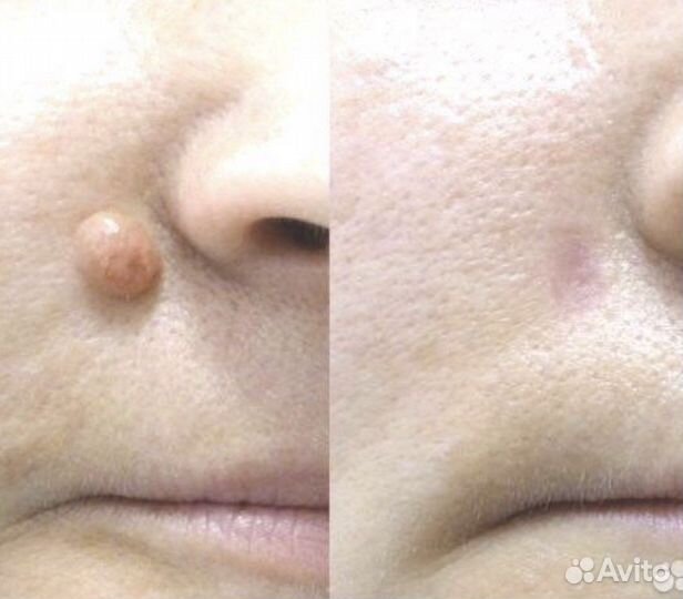 Удаление папиллом, родинок, бородавок