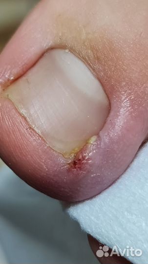 Приглашаем моделей на медицинский педикюр