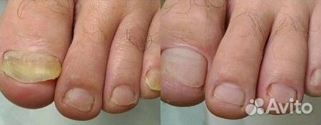 Средство от грибка ногтей широкого действия