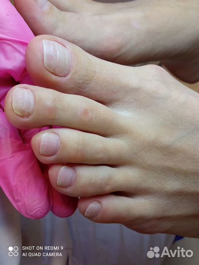 Педикюр медиц/маникюр/титановая нить/массаж