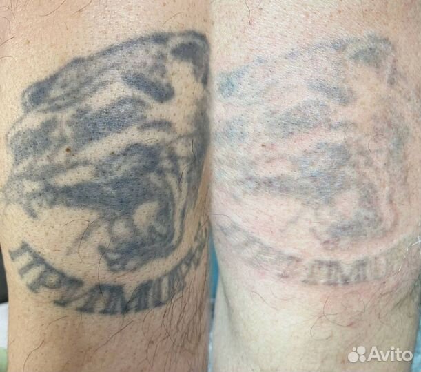 Удаление перманентного макияжа лазером