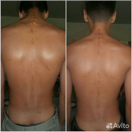 Массаж мануальный, костоправ. Результат с 1 сеанса