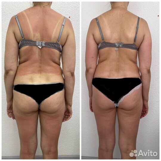 Коррекция фигуры/вакуумный массаж