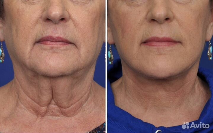 Модели на Кислородное Омоложение Декольте