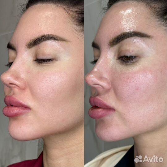 Фотоомоложение лица на IPL lumecca