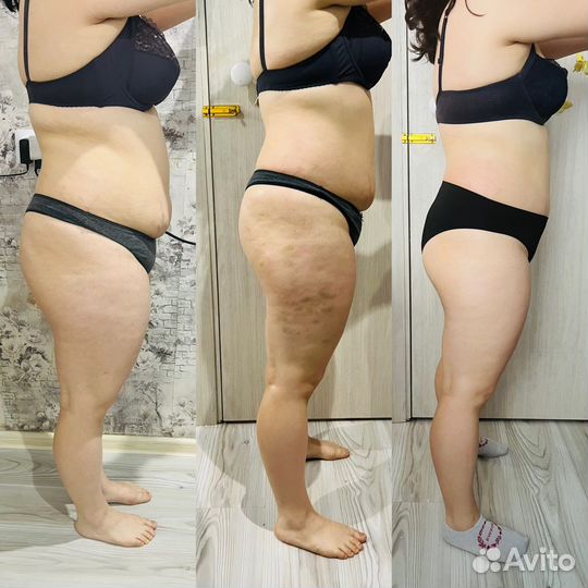 Аппаратная коррекция фигуры: вакуумный массаж