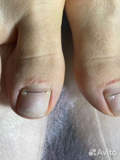 Подолог, установка титановой нити