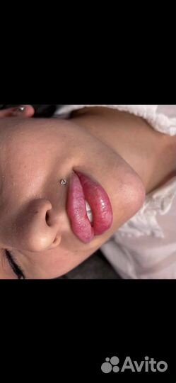 Модель Аугментация губ/ ронопластика