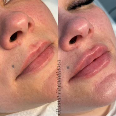 Модели. Контурная пластика губ