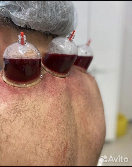 Хиджама (обучение )