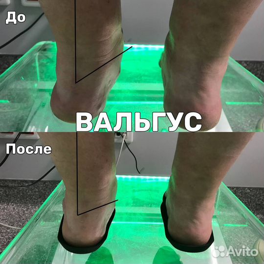 Стельки при плоскостопии заказать