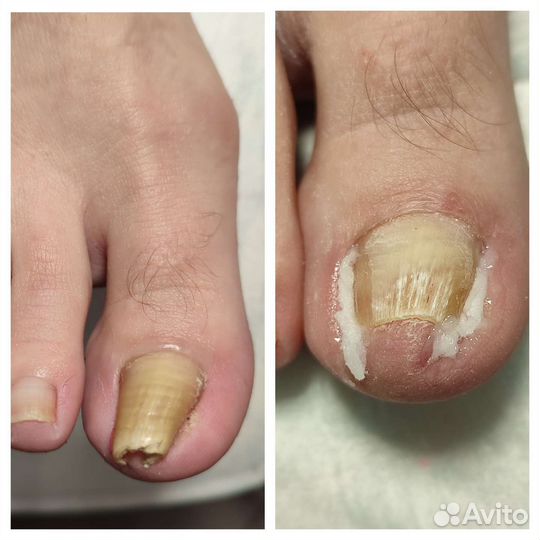 Педикюр, титановая нить, протезирование ногтей