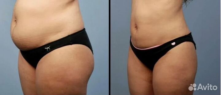 Липосакция, жиротоп и похудение Липосоникс