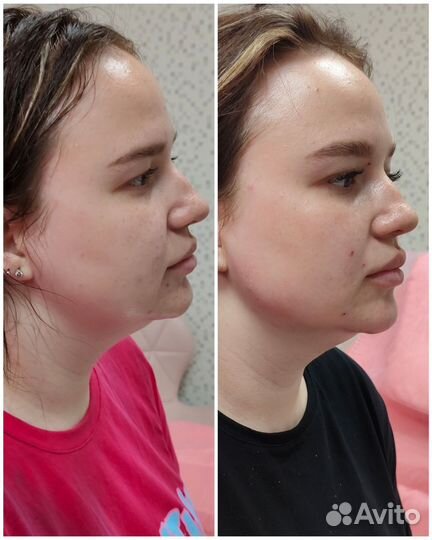 Контурная пластика лица