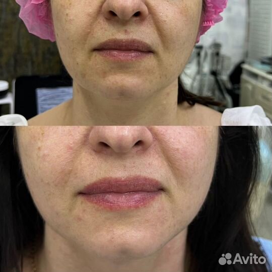 Смас-лифтинг Ультраформер (Ultraformer)