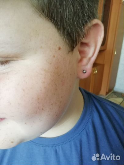 Карбокситерапия