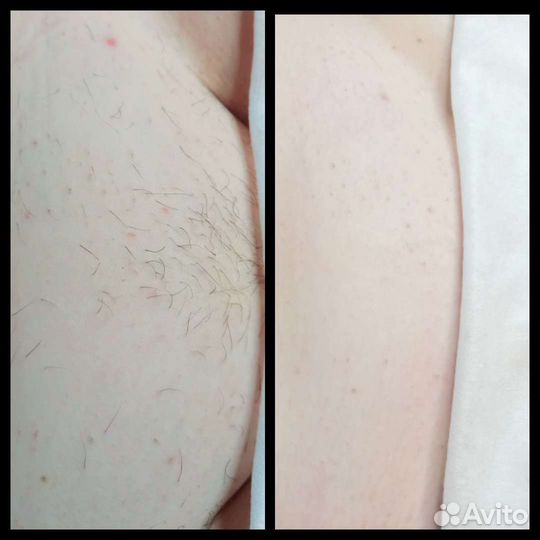 Шугаринг: руки выше локтя