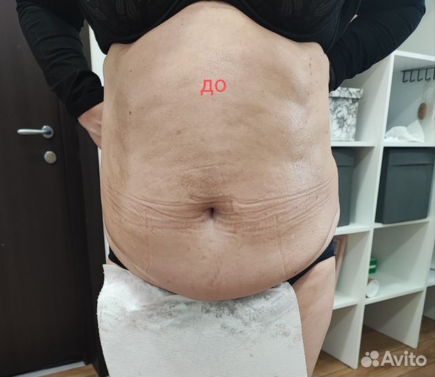 Аппаратный вакуумный массаж, кавитация,RFлифтинг