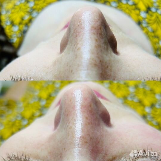 Чистка лица без боли