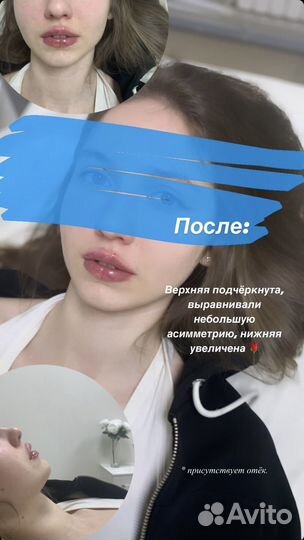 Увеличение губ