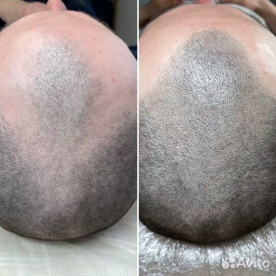 Трихопигментация для мужчин и женщин