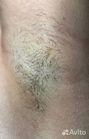 Электроэпиляция