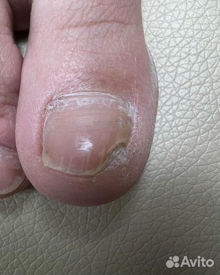 Протезирование ногтей