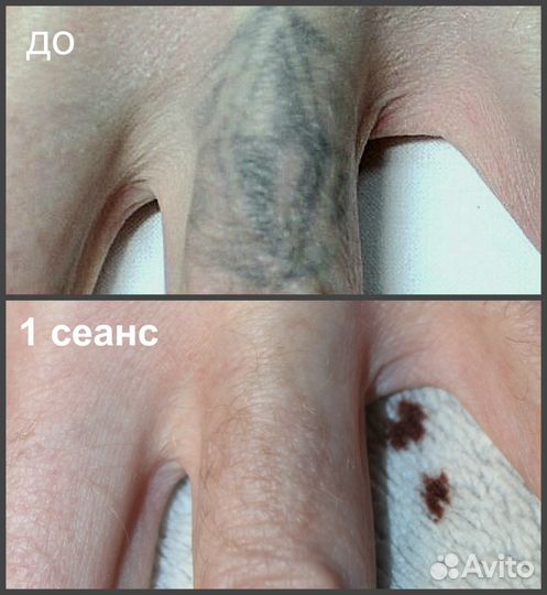 Лазерное удаление татуировок и татуажа бровей