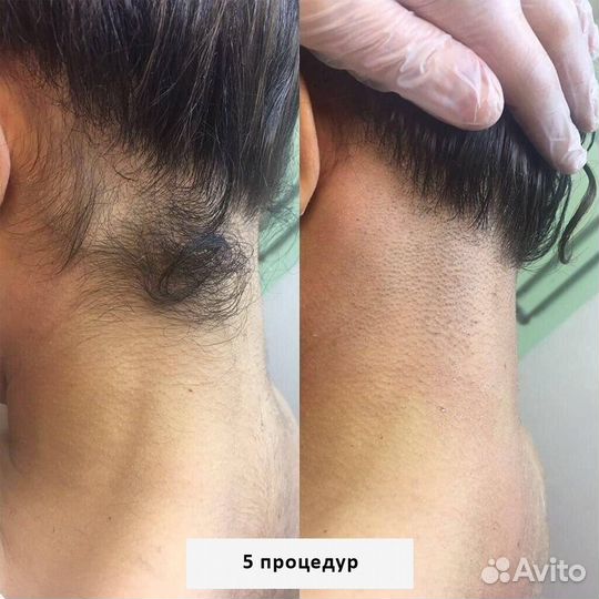 Лазерная эпиляция