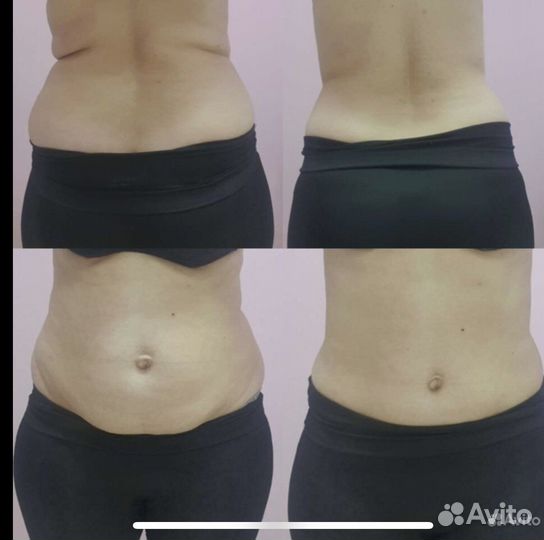 Криолиполиз Прессотерапия Миостимул-я Вакуумный мж