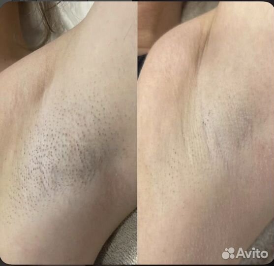 Лазерная эпиляция Диодный Лазер Депиляция