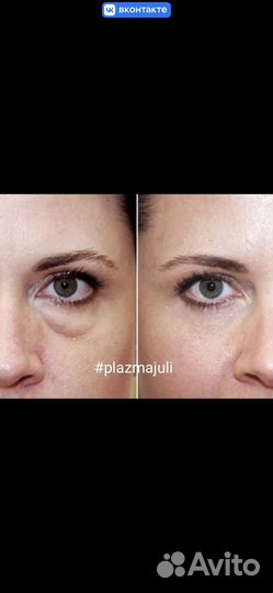 Холодная плазма