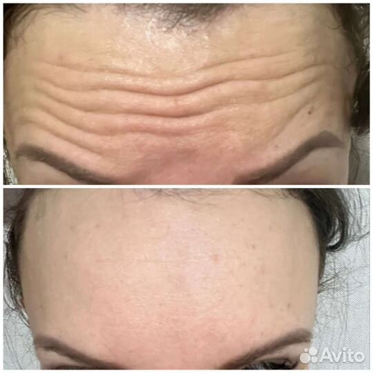 Биоревитализация