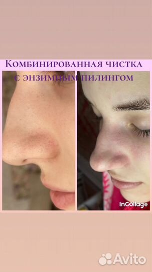 Косметолог, массаж лица, пилинг BioRePeel