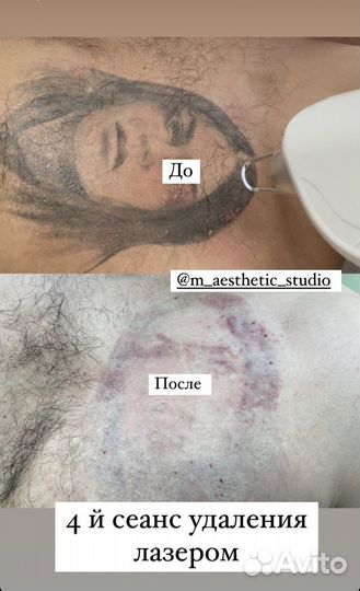 Аппаратная косметология