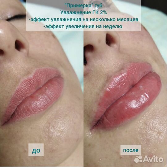 Красивые губы, увлажнение губ, Биоревитализация