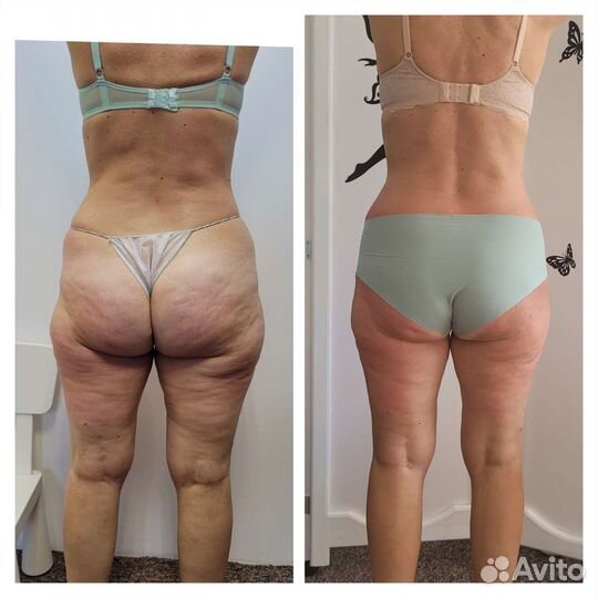 Lpg массаж тела